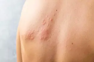 Herpes Zóster | EUROPA PRESS