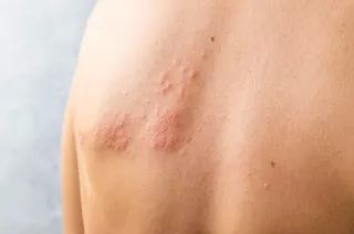 Herpes Zóster | EUROPA PRESS