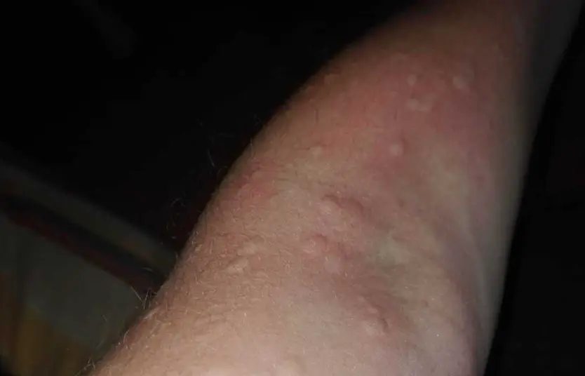 Marcas que le deja a Miryam la urticaria a frigore