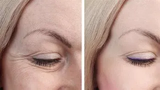 Blefaroplastia. EP