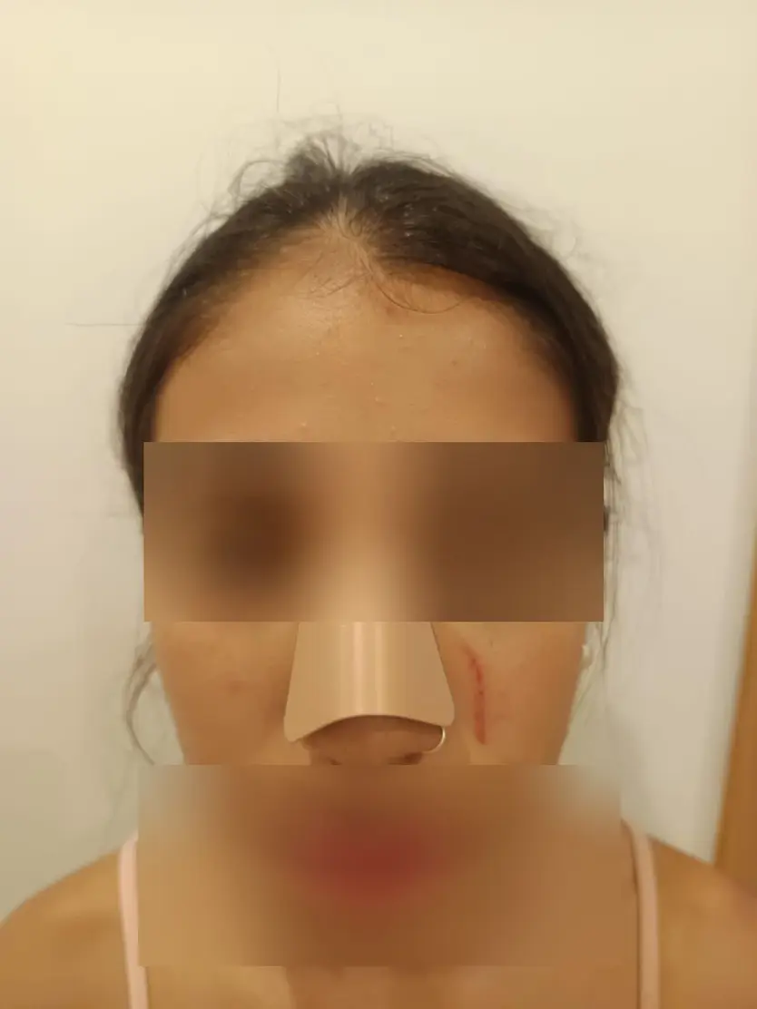 Lesiones que presentaba la niña una vez atendida por personal sanitario