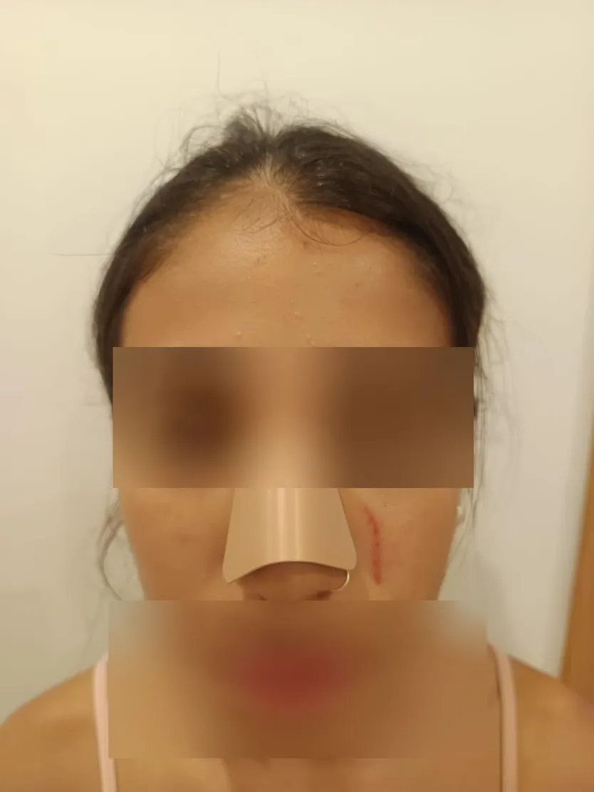 Lesiones que presentaba la niña una vez atendida por personal sanitario