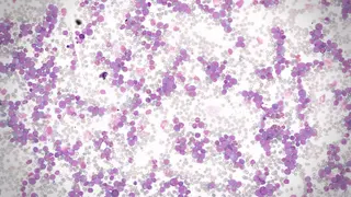 Un estudio liderado por el CIC revela un farmaco potenciador de los tratamientos contra la leucemia mieloide