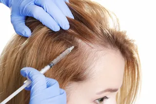 Alopecia femenina | Europa Press