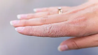 Dedo congelado