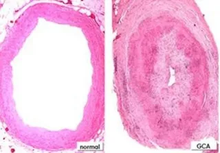 Identificados dos genes de riesgo para padecer arteritis de células gigantes