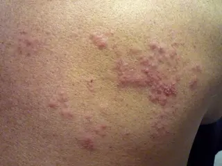 Herpes zóster. Foto Infosalus