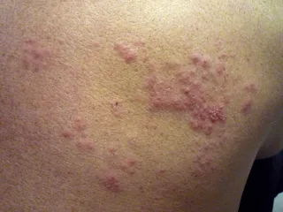 Herpes zóster. Foto Infosalus