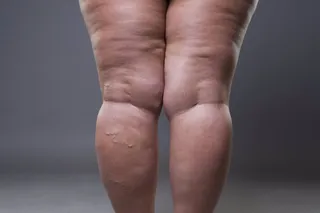 Piernas hinchadas | Fotografía Infosalus