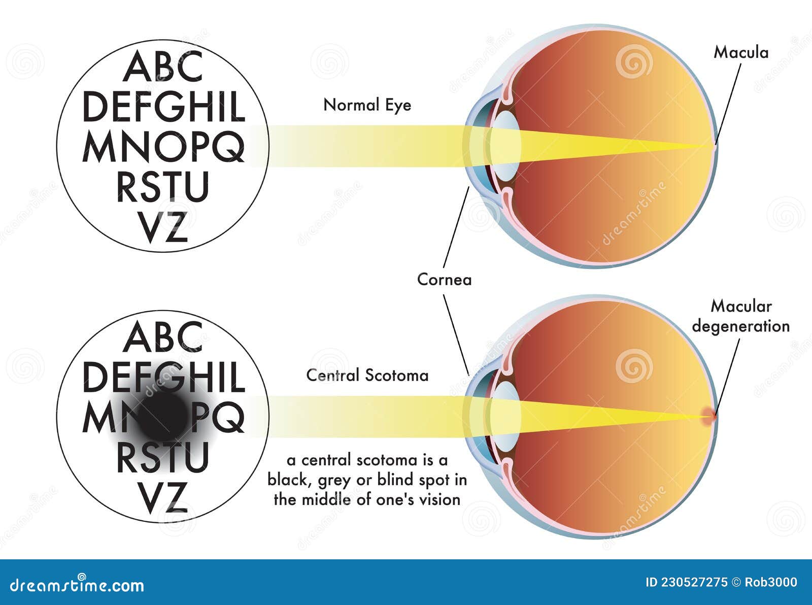 Ilustraci&oacute;n M&eacute;dica De Escotoma Central Ojo Humano Ilustrado Para Representar El Condici&oacute;n Incluyendo Degeneraci&oacute;n Macular. Dreamstime 