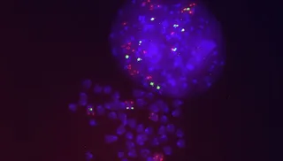 Tratamiento de cáncer de pulmón con sotorasib inhibidor de KRAS