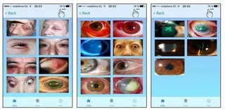 Una aplicación de telefonía para ayudar a médicos de Atención Primaria en el diagnóstico de enfermedades oftalmológicas
