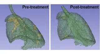 figura pulmones NORM