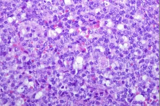 Relación entre glucosa y la leucemia linfoblástica aguda de células B