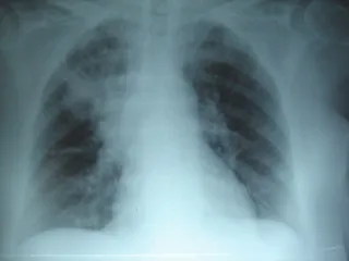 Neumonia