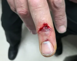 Mordisco interno a funcionario de Topas
