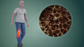 Osteoporosis