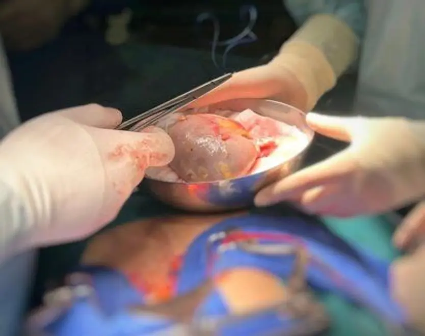 Trasplante renal