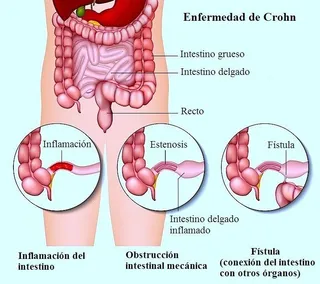 Diez consejos para controlar la Enfermedad de Crohn