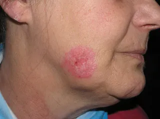 Enfermedad Lupus | Europa Press