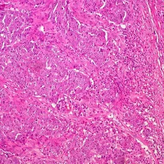 Cáncer de colon.