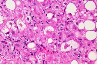 Tejido hepático afectado por la enfermedad del hígado graso no alcohólico. - DR. DAVID KLEINER, NCI - Archivo