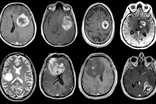 Esta es la novedosa terapia que podría mejorar la supervivencia de los pacientes con tumores cerebrales agresivos