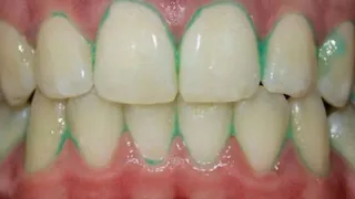 Dientes