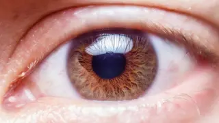 Glaucoma