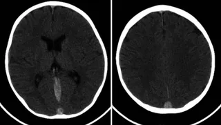 Neurólogos aclaran que solo 5% de pacientes con trombosis de senos venosos cerebrales desarrolla secuela severa