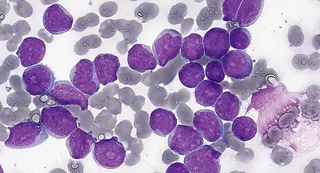 Investigadores del CIC participan en un proyecto internacional para identificar biomarcadores epigenéticos que detecten precozmente el riesgo de leucemia infantil