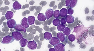 Investigadores del CIC participan en un proyecto internacional para identificar biomarcadores epigenéticos que detecten precozmente el riesgo de leucemia infantil