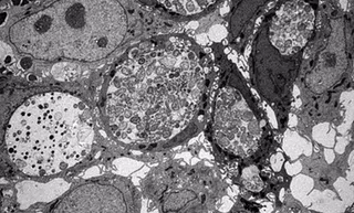 Imagen de microscopio electrónico de células intestinales humanas infectadas con Chlamydia trachomatis - PARGEV HOVHANNISYAN / UNIVERSITÄT WÜRZBURG