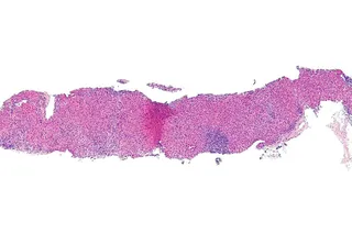 Hepatitis B 3
