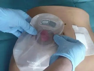 Ostomía