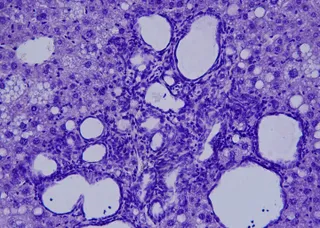 Colangiocarcinoma visto al microscopio.