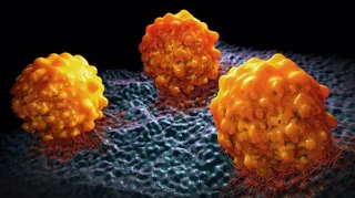 Cáncer de páncreas.
