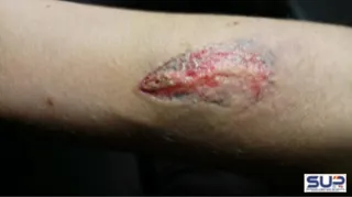 Herida Policía Salamanca antebrazo