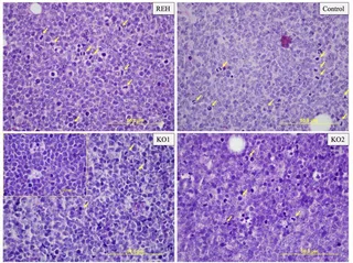 Leucemia aguda linfoblástica. Europa Press