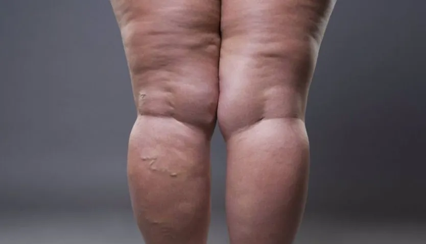 Lipedema