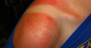 Un simple bronceado puede convertirse en una severa y permanente agresión a la piel