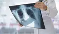 Radiografía sobre unos pulmones. Foto de Europapress