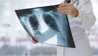Radiografía sobre unos pulmones. Foto de Europapress