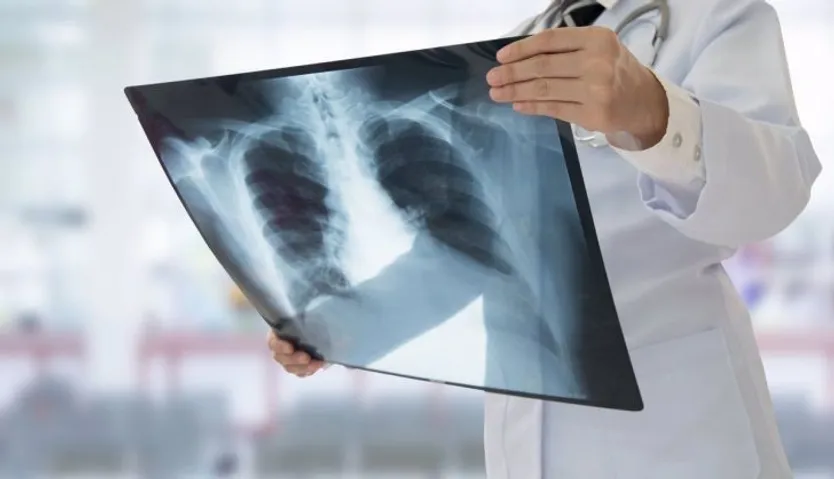 Cáncer de pulmón| EP