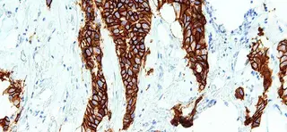 cáncer