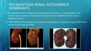 Poliquistosis renal, una enfermedad frecuente que todavía no tiene cura pero se puede erradicar