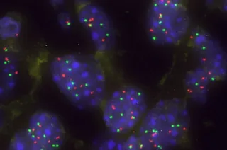 Descubierta una nueva vulnerabilidad en el cáncer de pulmón que abre vías para terapias personalizadas | Centro Investigación del Cáncer