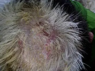 Pelo quemado