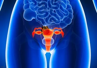 Cancer de cervix