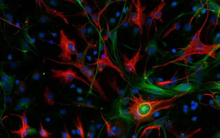 Glioblastoma mesenquimal de ratón. | CNIO
